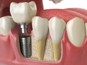 Rogersville Dental Implants